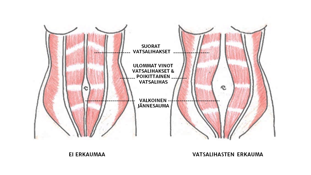erkauman leikkaushoidossa "karanneet" vatsalihakset ommellaan takaisin yhteen