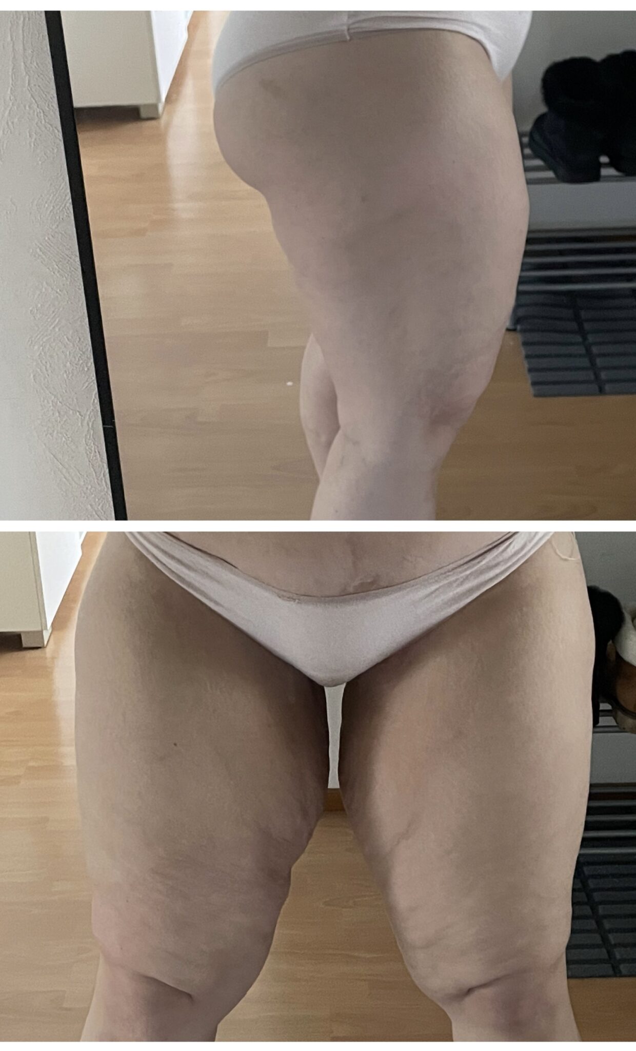 Kuvassa reidet, jotka omasta mielestäni vaatisi kauneusleikkausta. Roikkuvaa nahkaa ja rasvaa on vielä jäljellä