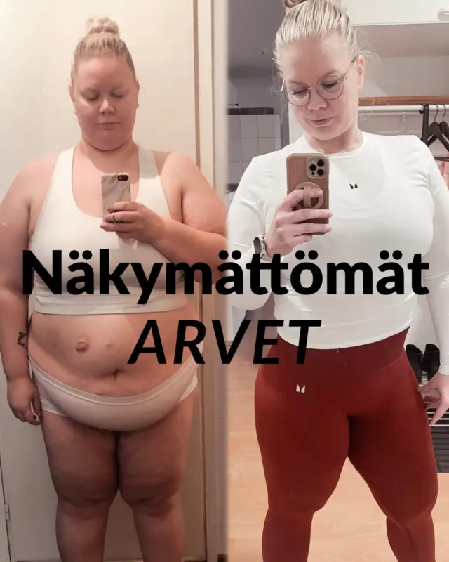 Näkyvät arvet paranevat ajan kanssa. Niitä voi peittää, hoitaa ja oppia katsomaan lempeämmin 🩷

Mutta ne näkymättömät arvet… ne kulkevat mukana paljon pidempään❤️‍🩹

Kun koko elämäsi olet kokenut olevasi “se isompi”, näkymätön tai vääränlainen, ei mieli aina pysy mukana siinä muutoksessa, vaikka peilikuva muuttuu. Vasta nyt olen alkanut ymmärtää, miten paljon ulkonäkö vaikuttaa siihen, miten muut kohtelevat – ja samalla siihen, miten itse uskaltaa olla.

Se tuntuu samaan aikaan hyvältä ja surulliselta.

Hyvältä, koska olen nykyään itsevarmempi, uskallan katsoa silmiin, hymyillä ja ottaa tilaa.

Surulliselta, koska se vanha minä ei koskaan saanut kokea sitä. Hänkin olisi ansainnut tulla nähdyksi, kohdatuksi ja kauniiksi juuri sellaisena kuin oli.

Painonpudotus muutti paljon. Ei pelkästään kehoa, vaan myös sitä, miten maailma reagoi minuun. Ja ehkä suurin työ ei olekaan ollut fyysinen muutos – vaan se, että opettelen hyväksymään kaikki ne näkyvät ja näkymättömät arvet, joita matkan varrelle jäi 🤍

Tykkää, jaa, kommentoi, tallenna tämä postaus. Toivon, että tämä tavoittaisi mahdollisimman monen henkilön 🩷

#elämäntapamuutos #arvet #henkisetarvet #painonpudotus
